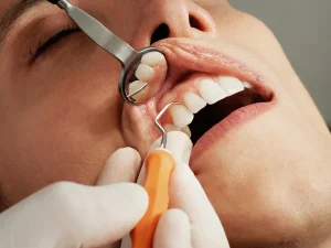 Gum Disease and Heart Disease: Complicated Relationships Part 2