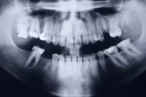 Wisdom Teeth Removal: Extraction vs Surgery