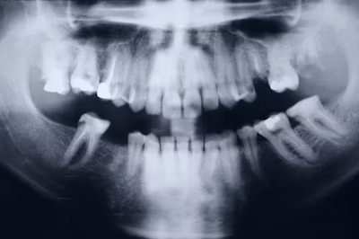 Wisdom Teeth Removal: Extraction vs Surgery