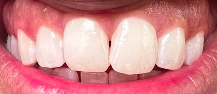 Understanding Demineralisation: Causes, Symptoms, and Prevention