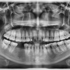 Dental X-rays (OPG, PA or CBCT) - Maple Dental