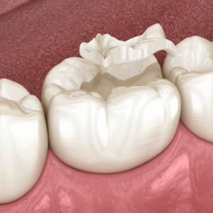 Inlays and Onlays - Maple Dental