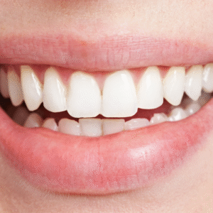 Teeth Straightening - Maple Dental