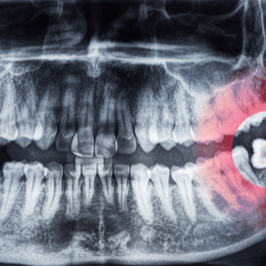 Wisdom Tooth Surgery - Maple Dental
