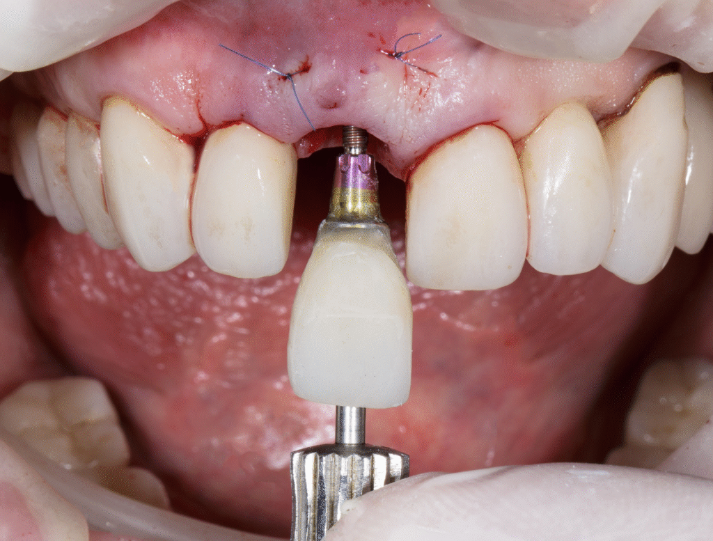 Dental Implant Crown - Maple Dental (Kovan)