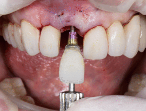 Dental Implant Crown - Maple Dental (Kovan)