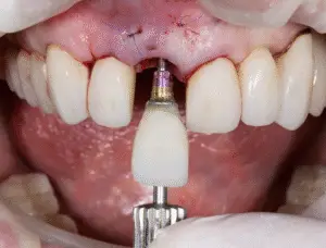 Dental Implant Crown - Maple Dental (Kovan)