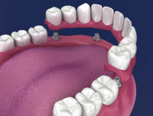 Dentures vs Dental Implants - Maple Dental