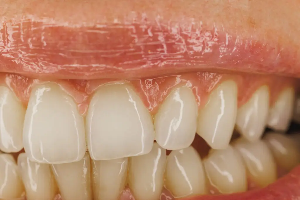 Bleeding gums