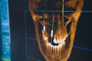 3D CBCT Scans for Dental Implants
