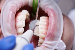 6 monthly dental cleaning (scaling and polishing)