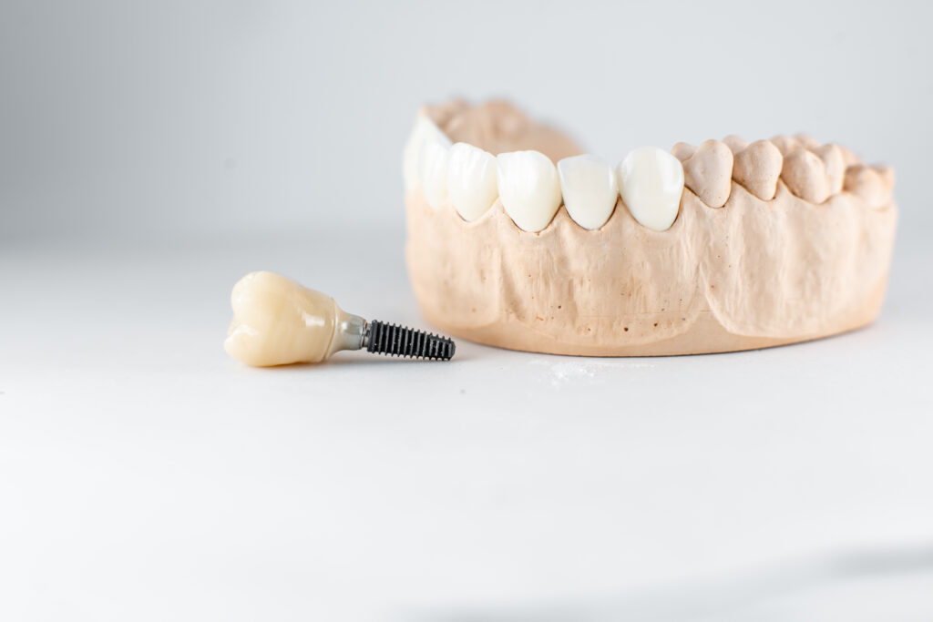 Dental implants model with dental implant screw