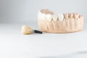 Dental implants model with dental implant screw