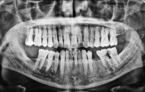 Patient that might require bone graft