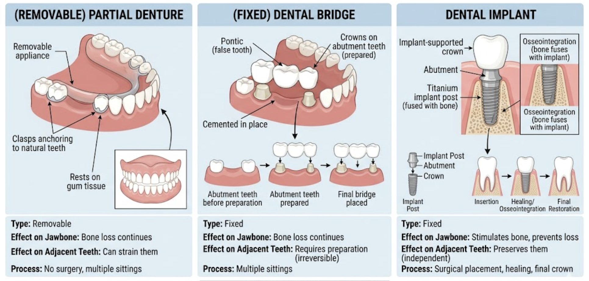 Infographic comparing three tooth replacement options: removable partial denture, fixed dental bridge, and dental implant &mdash; showing differences in type, effect on jawbone, effect on adjacent teeth, and process