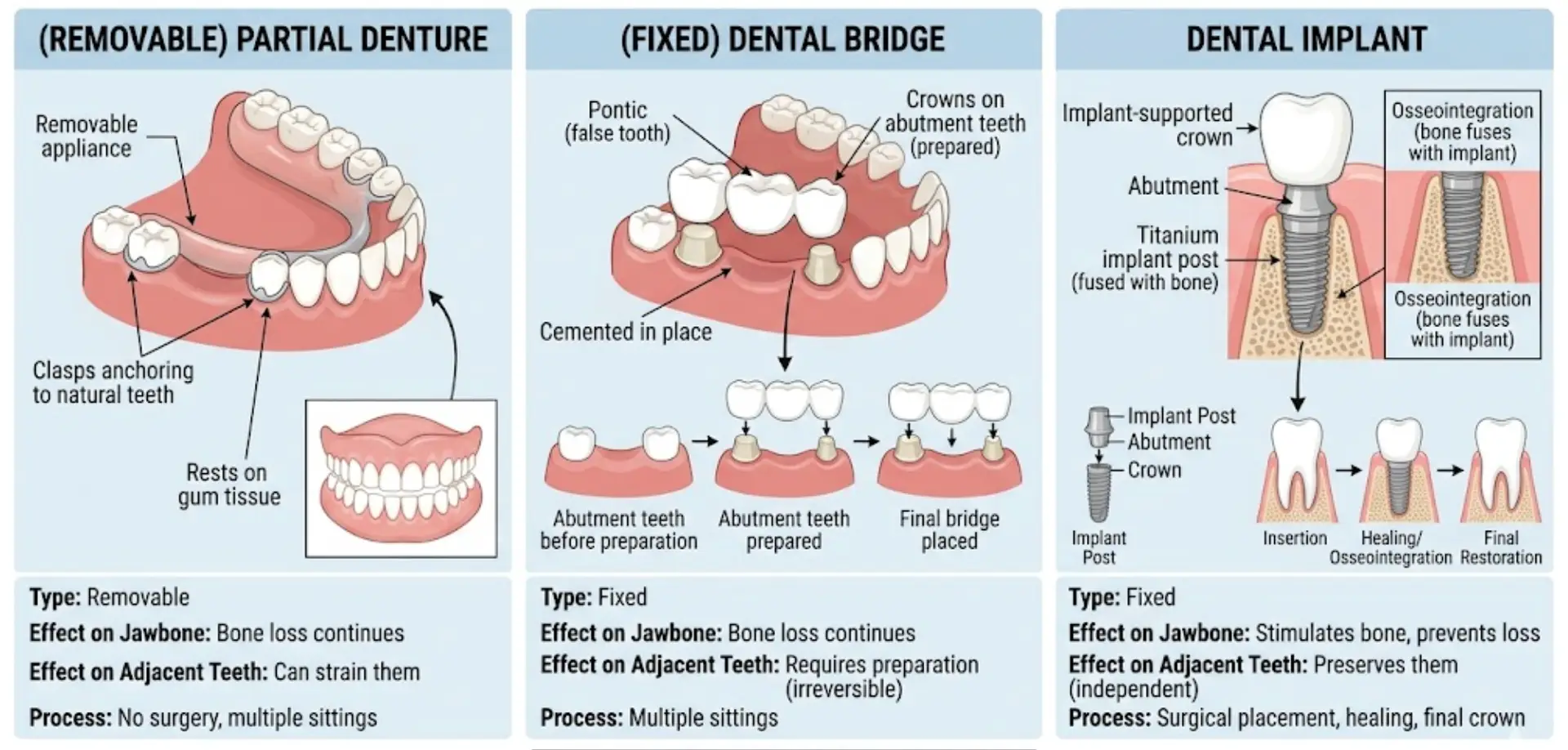 Infographic comparing three tooth replacement options: removable partial denture, fixed dental bridge, and dental implant — showing differences in type, effect on jawbone, effect on adjacent teeth, and process